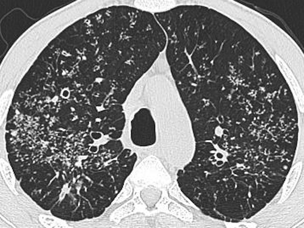 tuberculosis.gif