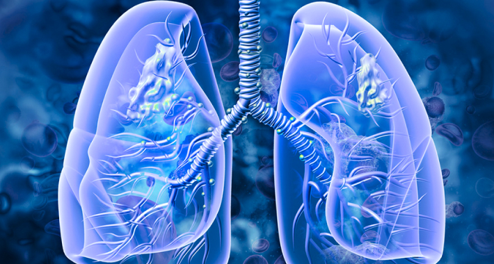 Lung cancer